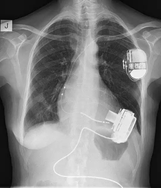 x-ray of lvad patient